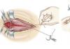 Surgical sutures Surgery types of sutures